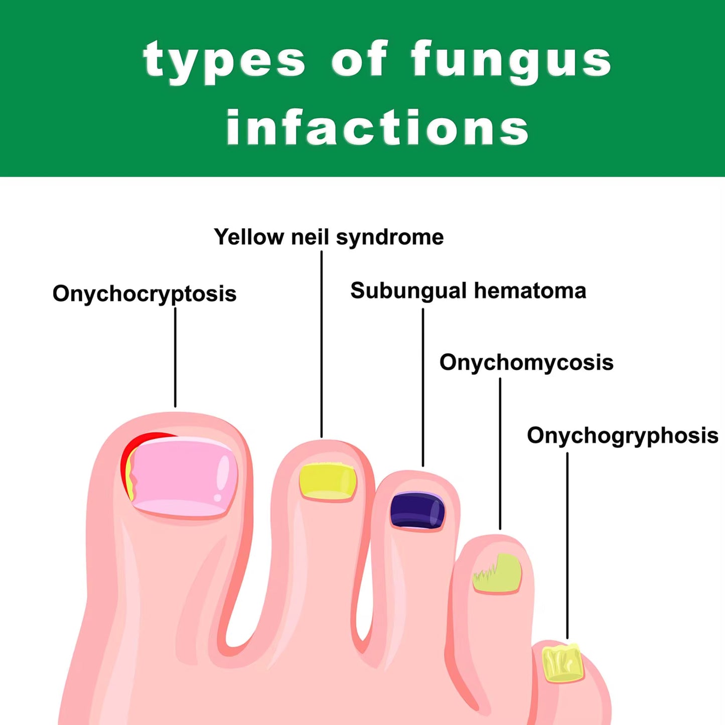 Nail fungus treatment