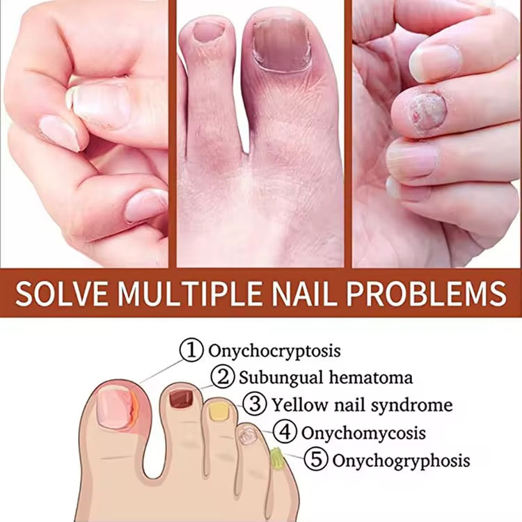 Nail fungus treatment