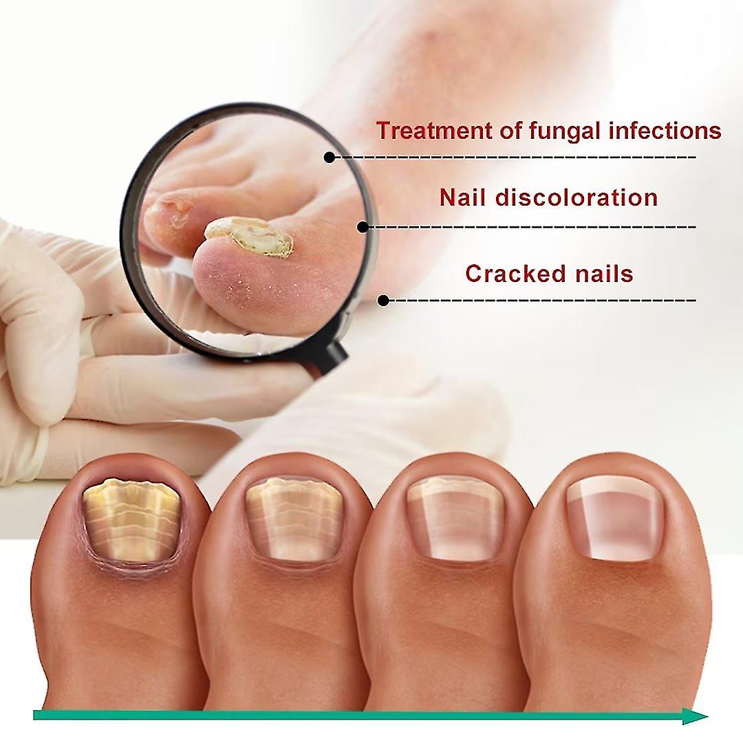 Nail fungus treatment
