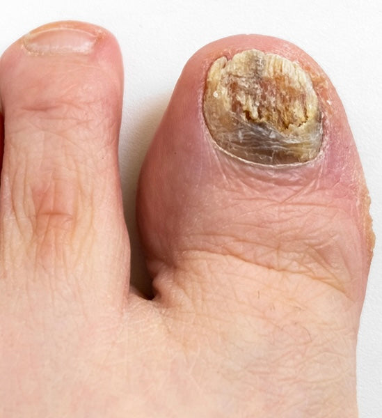 Nail fungus treatment