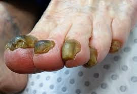 Nail fungus treatment